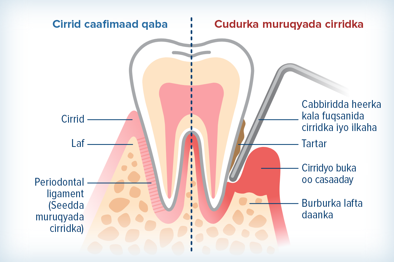 garaaf-macluumaadeed muujinaya farqiga u dhexeeya cirridka caafimaadka qaba iyo cirridka qaba cudurka waxyeeleeya ciridka iyo lafta daanka.